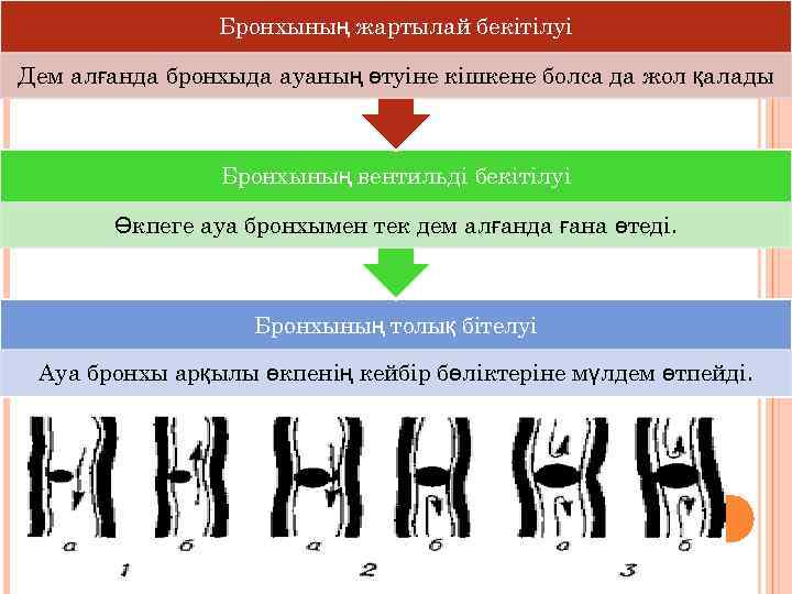 Бронхының жартылай бекітілуі Дем алғанда бронхыда ауаның өтуіне кішкене болса да жол қалады Бронхының