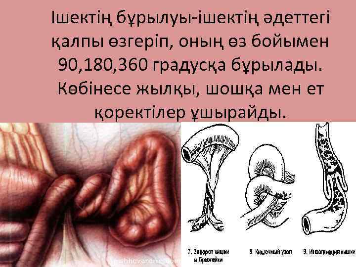 Ішектің бұрылуы-ішектің әдеттегі қалпы өзгеріп, оның өз бойымен 90, 180, 360 градусқа бұрылады. Көбінесе