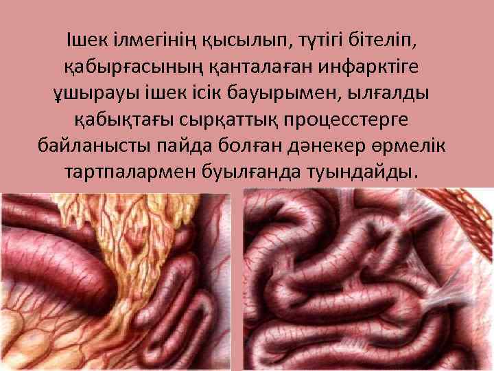 Ішек ілмегінің қысылып, түтігі бітеліп, қабырғасының қанталаған инфарктіге ұшырауы ішек ісік бауырымен, ылғалды қабықтағы