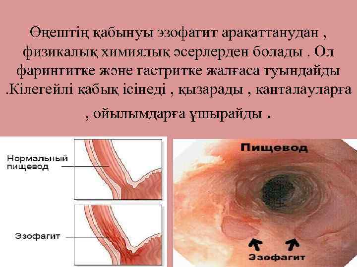 Өңештің қабынуы эзофагит арақаттанудан , физикалық химиялық әсерлерден болады. Ол фарингитке және гастритке жалғаса