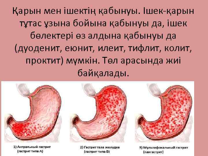 Қарын мен ішектің қабынуы. Ішек-қарын тұтас ұзына бойына қабынуы да, ішек бөлектері өз алдына