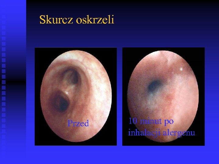Skurcz oskrzeli Przed 10 minut po inhalacji alergenu P Howarth 
