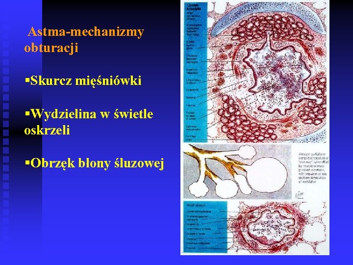 Astma-mechanizmy obturacji §Skurcz mięśniówki §Wydzielina w świetle oskrzeli §Obrzęk błony śluzowej 
