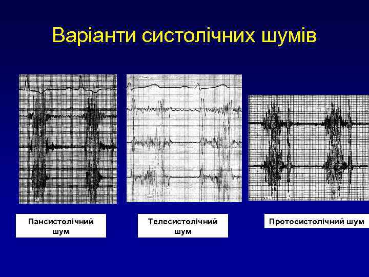 Варіанти систолічних шумів Пансистолічний шум Телесистолічний шум Протосистолічний шум 