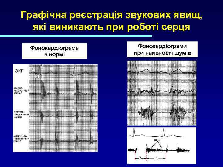Графічна реєстрація звукових явищ, які виникають при роботі серця Фонокардіограма в нормі Фонокардіограми при