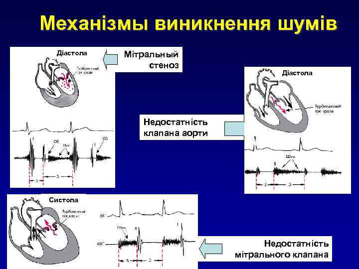 Механізмы виникнення шумів Діастола Мітральный стеноз Діастола Недостатність клапана аорти Систола Недостатність мітрального клапана