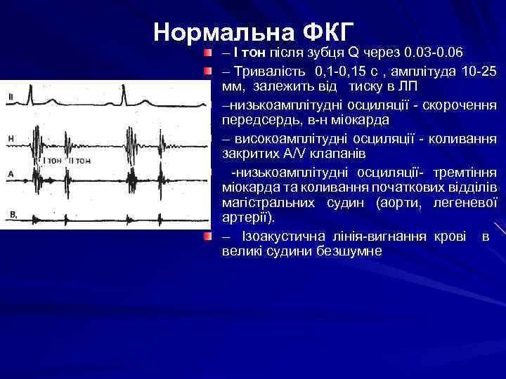 Нормальна ФКГ – І тон після зубця Q через 0. 03 -0. 06 –