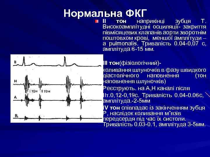 Нормальна ФКГ ІІ тон наприкінці зубця Т. Високоамплітудні осциляції- закриття півмісяцевих клапанів аорти зворотнім