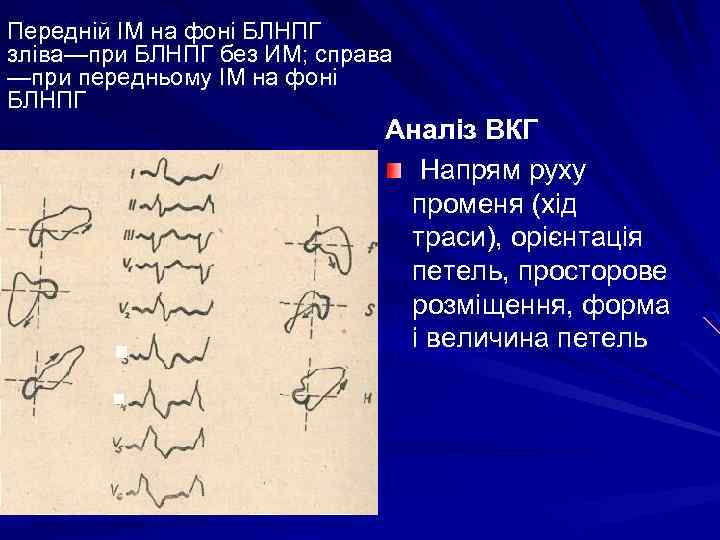 Передній ІМ на фоні БЛНПГ зліва—при БЛНПГ без ИМ; справа —при передньому ІМ на