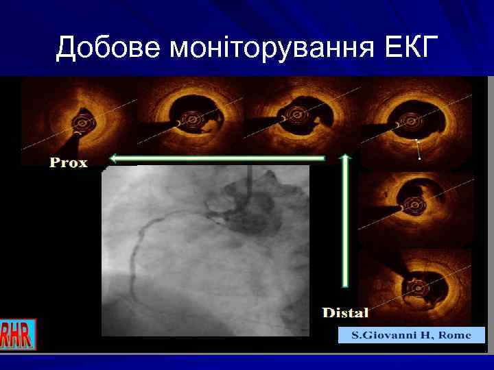 Добове моніторування ЕКГ 