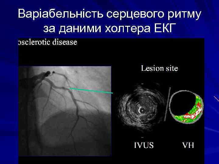 Варіабельність серцевого ритму за даними холтера ЕКГ 