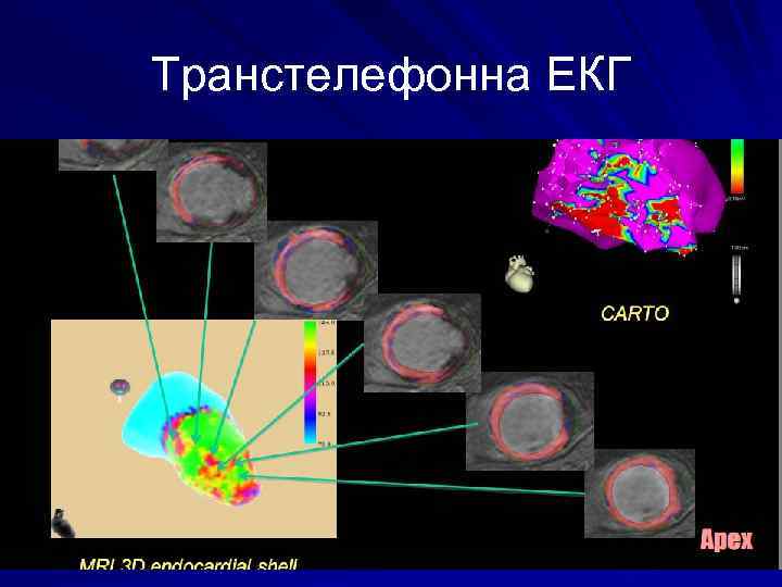 Транстелефонна ЕКГ 