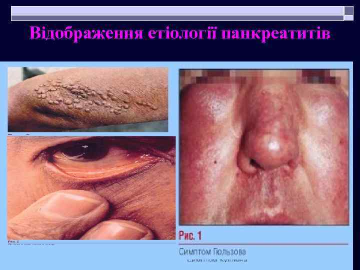 Відображення етіології панкреатитів 