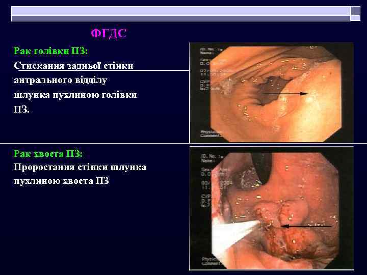 ФГДС Рак голівки ПЗ: Стискання задньої стінки антрального відділу шлунка пухлиною голівки ПЗ. Рак