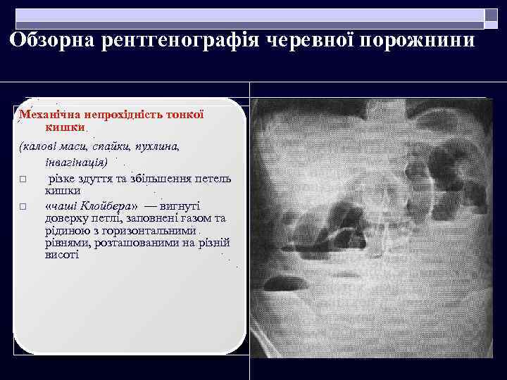 Обзорна рентгенографія черевної порожнини Механічна непрохідність тонкої кишки (калові маси, спайки, пухлина, інвагінація) o
