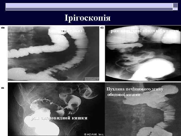  Ірігоскопія дивертикульоз рак висхідної ободової кишки Пухлина печінкового згину ободової кишки рак сигмовидной