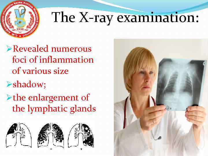 The X-ray examination: ØRevealed numerous foci of inflammation of various size Øshadow; Øthe enlargement