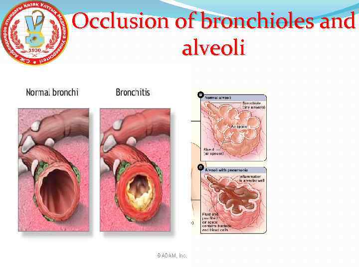 Occlusion of bronchioles and alveoli 