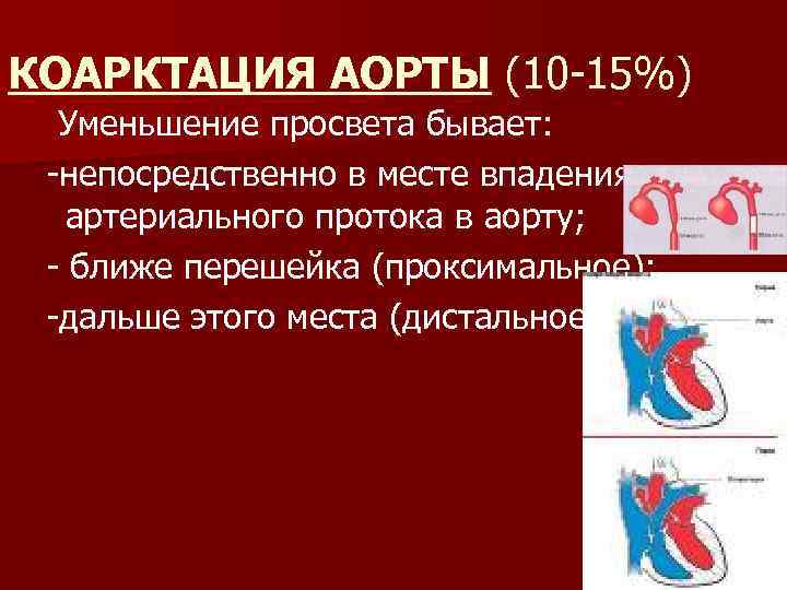 КОАРКТАЦИЯ АОРТЫ (10 -15%) Уменьшение просвета бывает: -непосредственно в месте впадения артериального протока в