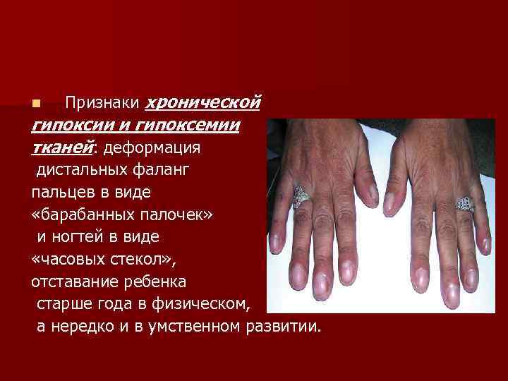 n Признаки хронической гипоксии и гипоксемии тканей: деформация дистальных фаланг пальцев в виде «барабанных
