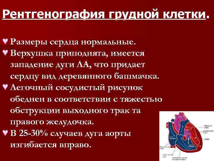 Рентгенография грудной клетки. ♥ Размеры сердца нормальные. ♥ Верхушка приподнята, имеется западение дуги ЛА,