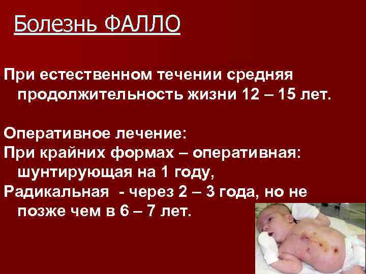 Болезнь ФАЛЛО При естественном течении средняя продолжительность жизни 12 – 15 лет. Оперативное лечение:
