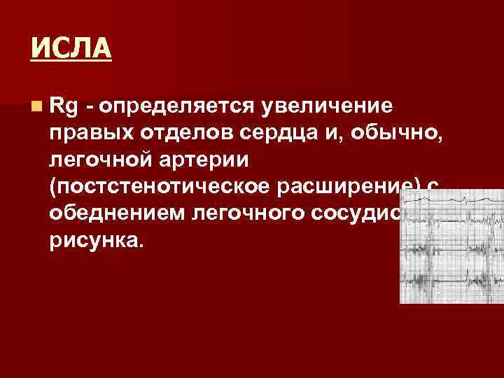 ИСЛА n Rg определяется увеличение правых отделов сердца и, обычно, легочной артерии (постстенотическое расширение)