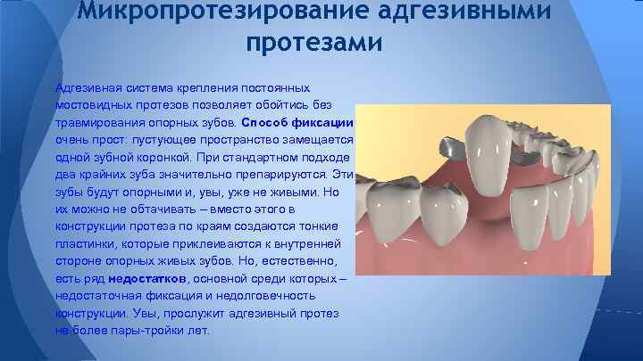 Адгезивное протезирование. Адгезивная фиксация коронок. Адгезивный микропротез. Микропротезирование адгезивными протезами. Микропротезирование в ортопедической стоматологии.