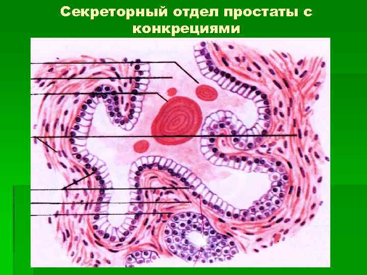 Секреторный отдел простаты с конкрециями 