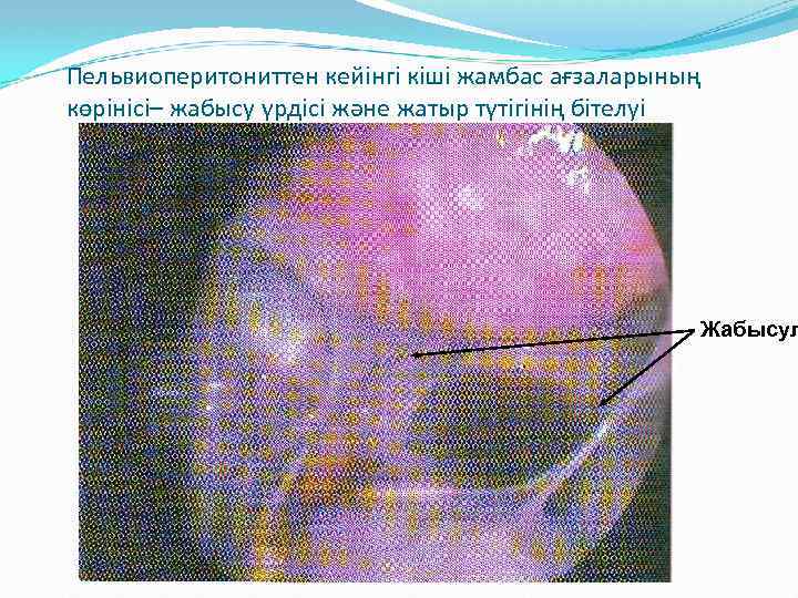 Пельвиоперитониттен кейінгі кіші жамбас ағзаларының көрінісі– жабысу үрдісі және жатыр түтігінің бітелуі Жабысул 