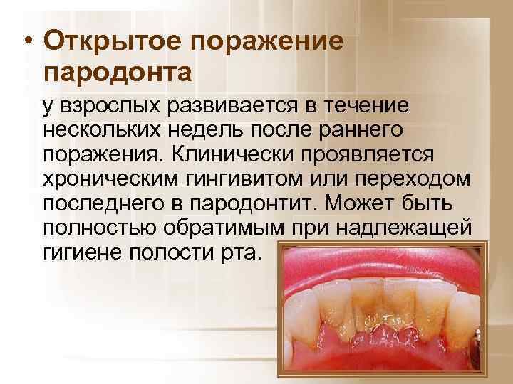  • Открытое поражение пародонта у взрослых развивается в течение нескольких недель после раннего