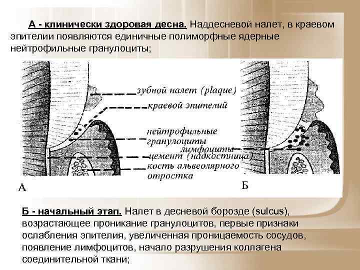 А - клинически здоровая десна. Наддесневой налет, в краевом эпителии появляются единичные полиморфные ядерные