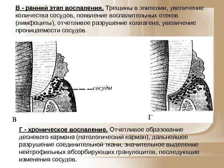 В - ранний этап воспаления. Трещины в эпителии, увеличение количества сосудов, появление воспалительных отеков