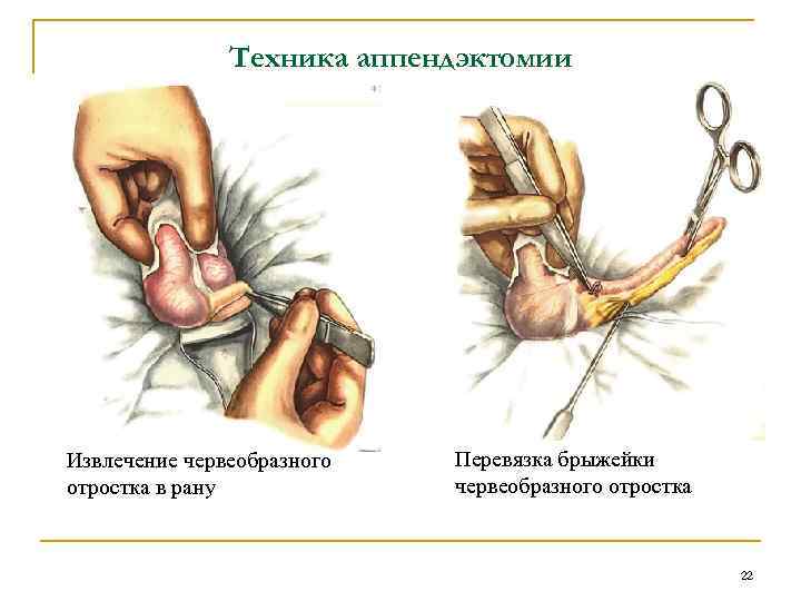 Техника аппендэктомии Извлечение червеобразного отростка в рану Перевязка брыжейки червеобразного отростка 22 