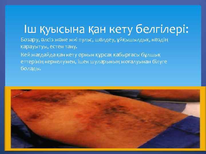 Іш қуысына қан кету белгілері: Бозару, әлсіз және жиі пульс, шөлдеу, ұйқышылдық, көздің қарауытуы,