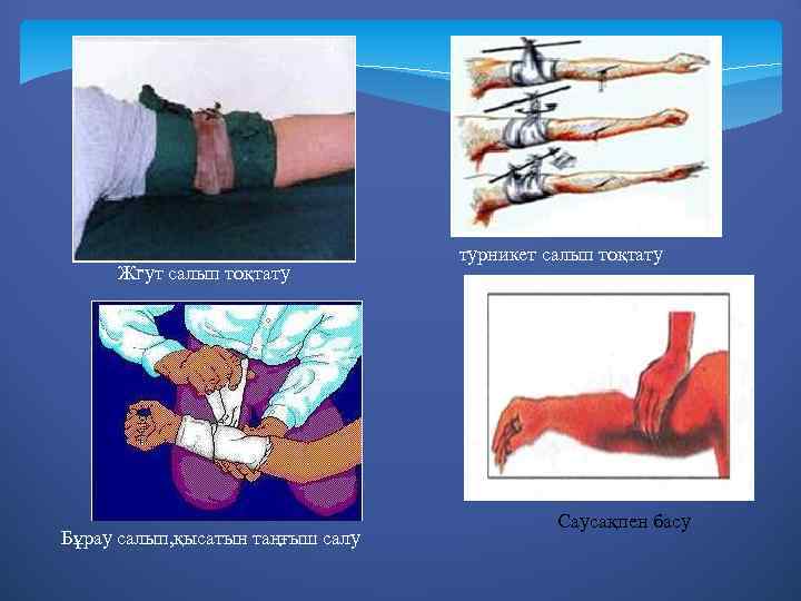 Жгут салып тоқтату Бұрау салып, қысатын таңғыш салу турникет салып тоқтату Саусақпен басу 