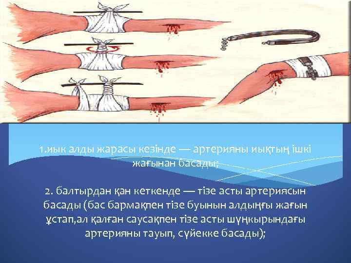 1. иык алды жарасы кезінде — артерияны иықтың ішкі жағынан басады; 2. балтырдан қан