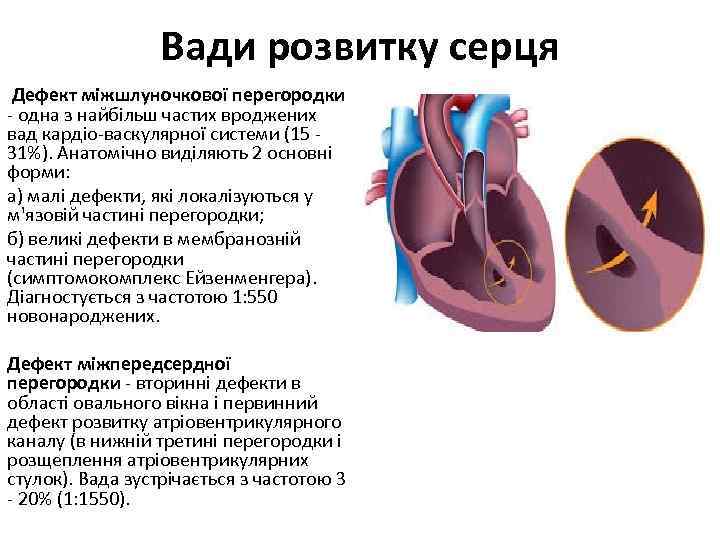 Вади розвитку серця Дефект міжшлуночкової перегородки - одна з найбільш частих вроджених вад кардіо-васкулярної