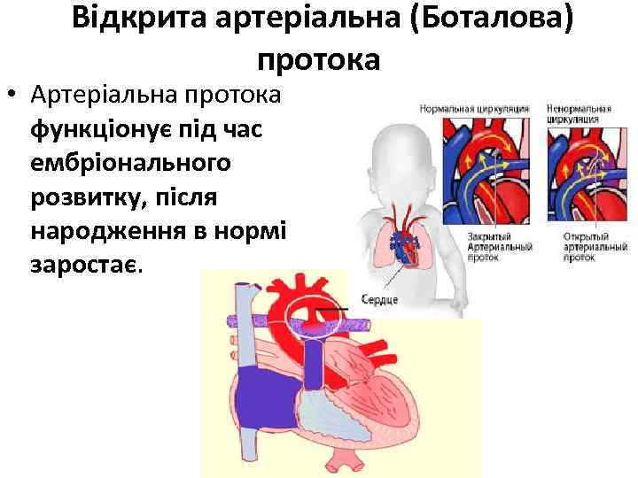 Відкрита артеріальна (Боталова) протока • Артеріальна протока функціонує під час ембріонального розвитку, після
