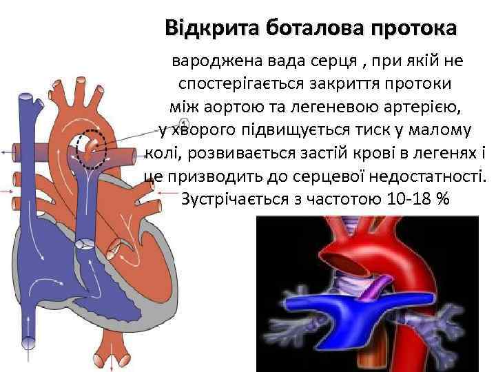 Відкрита боталова протока вароджена вада серця , при якій не спостерігається закриття протоки між