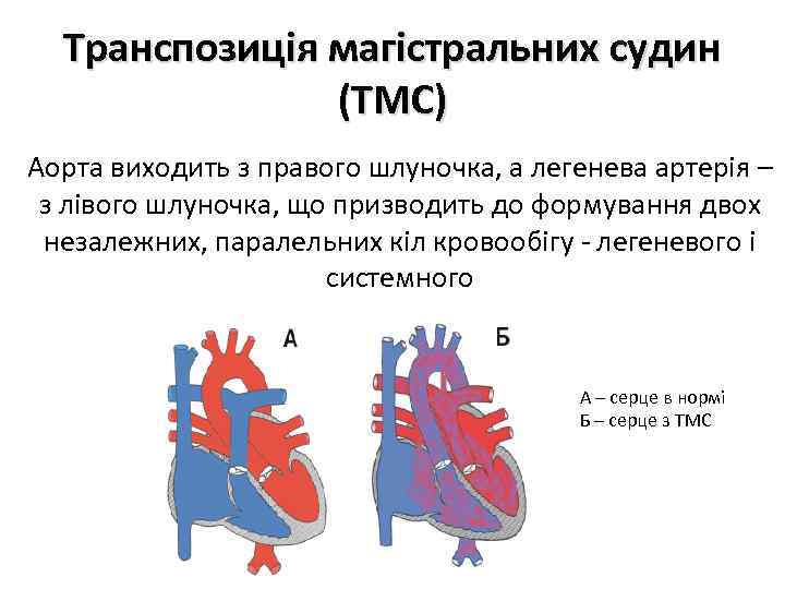 Транспозиція магістральних судин (ТМС) Аорта виходить з правого шлуночка, а легенева артерія – з