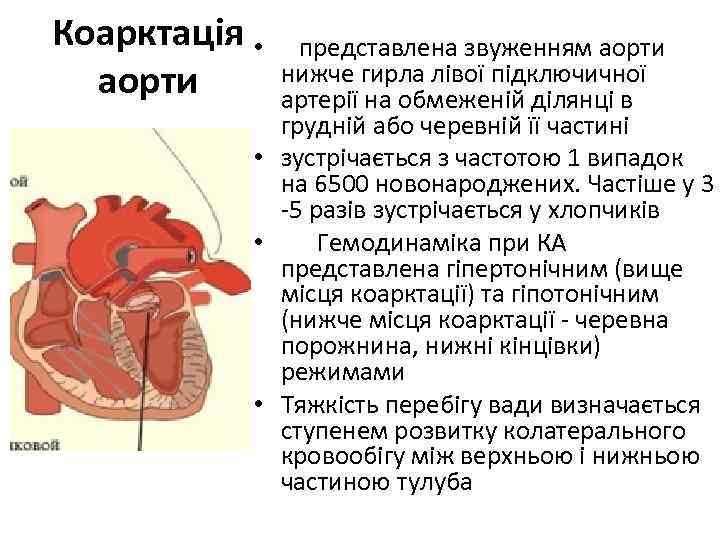  Коарктацiя • представлена звуженням аорти нижче гирла лiвої пiдключичної аорти артерiї на обмеженiй