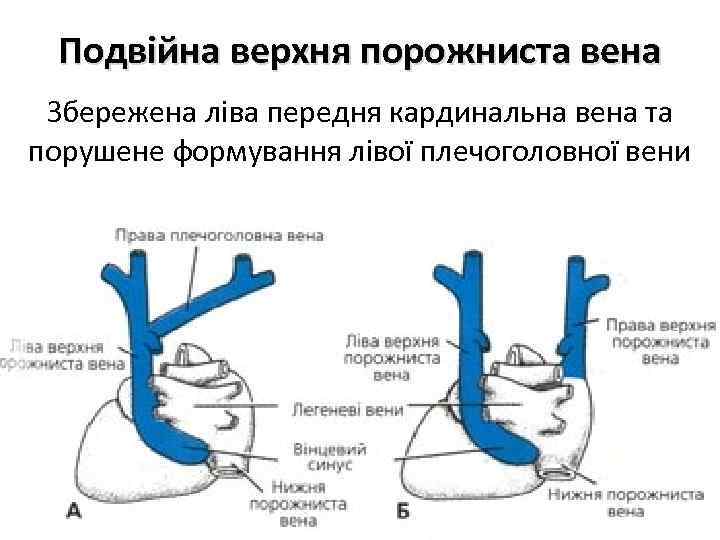 Подвійна верхня порожниста вена Збережена ліва передня кардинальна вена та порушене формування лівої плечоголовної