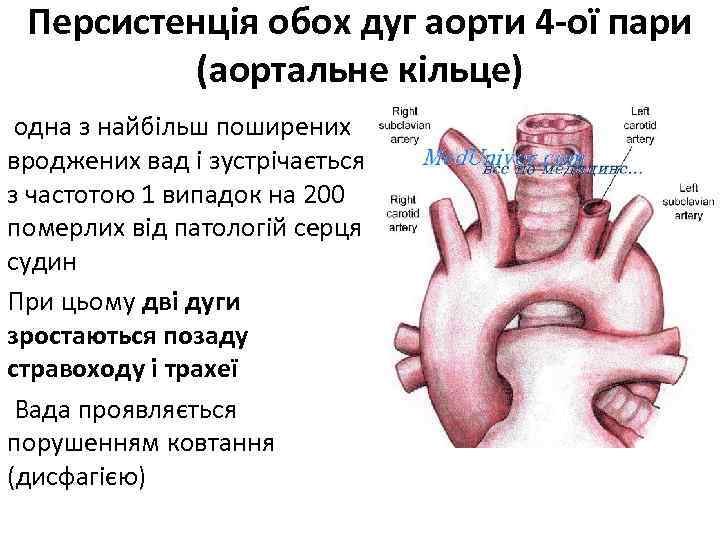 Персистенція обох дуг аорти 4 -ої пари (аортальне кільце) одна з найбільш поширених вроджених