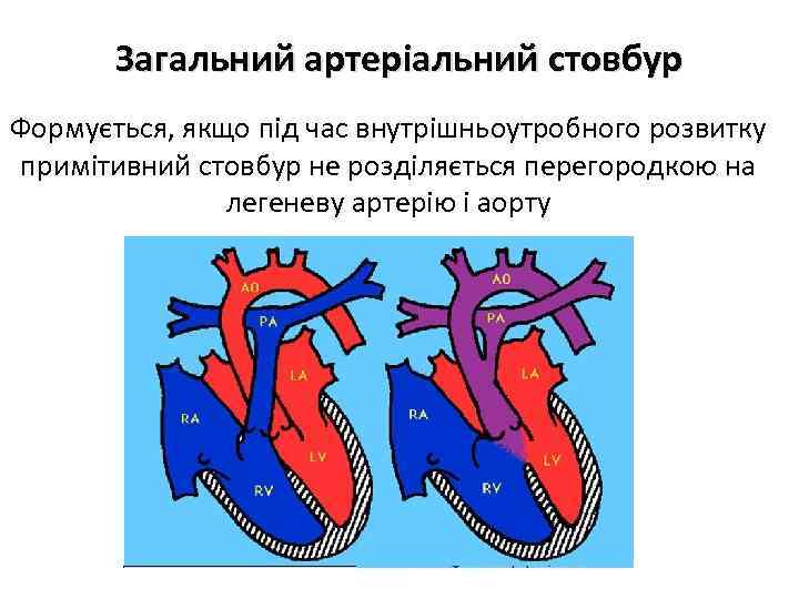 Загальний артеріальний стовбур Формується, якщо під час внутрішньоутробного розвитку примітивний стовбур не розділяється перегородкою