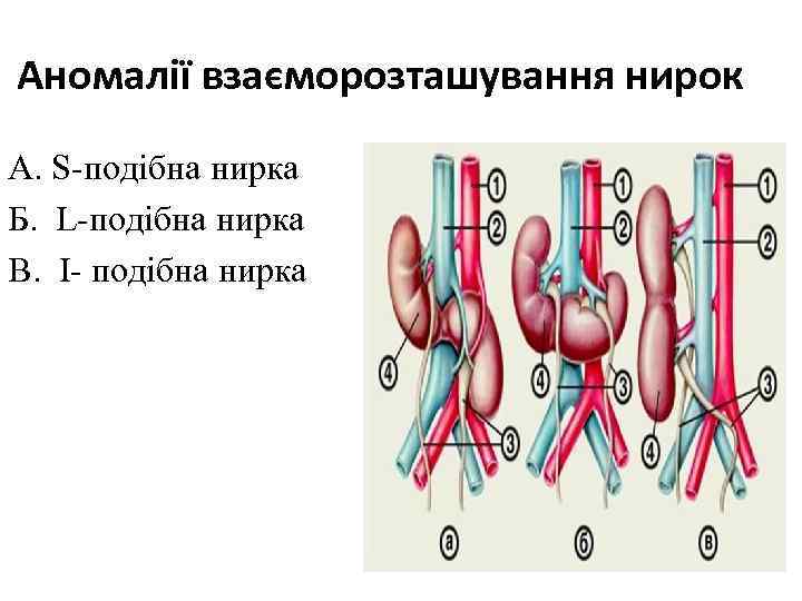 Аномалії взаєморозташування нирок А. S-подібна нирка Б. L-подібна нирка В. І- подібна нирка 