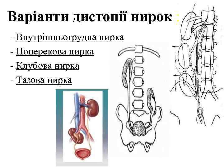 Варіанти дистопії нирок : - Внутрішньогрудна нирка - Поперекова нирка - Клубова нирка -