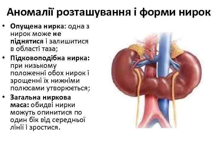 Аномалії розташування і форми нирок • Опущена нирка: одна з нирок може не піднятися