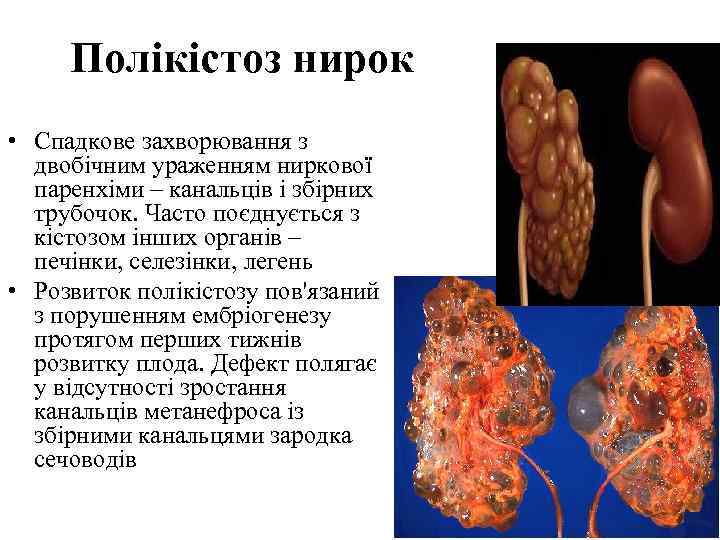 Полікістоз нирок • Спадкове захворювання з двобічним ураженням ниркової паренхіми – канальців і збірних