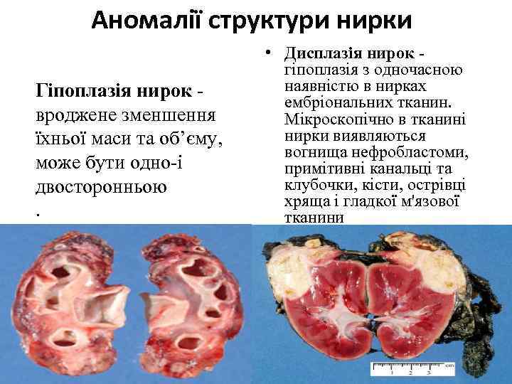 Аномалії структури нирки Гіпоплазія нирок вроджене зменшення їхньої маси та об’єму, може бути одно-і